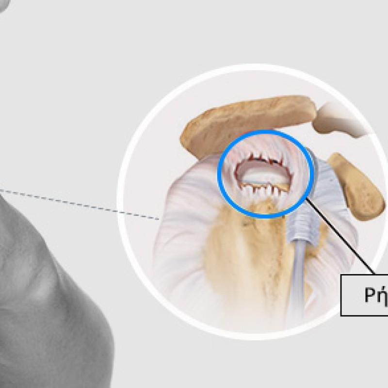 Ρήξη υπερακανθίου