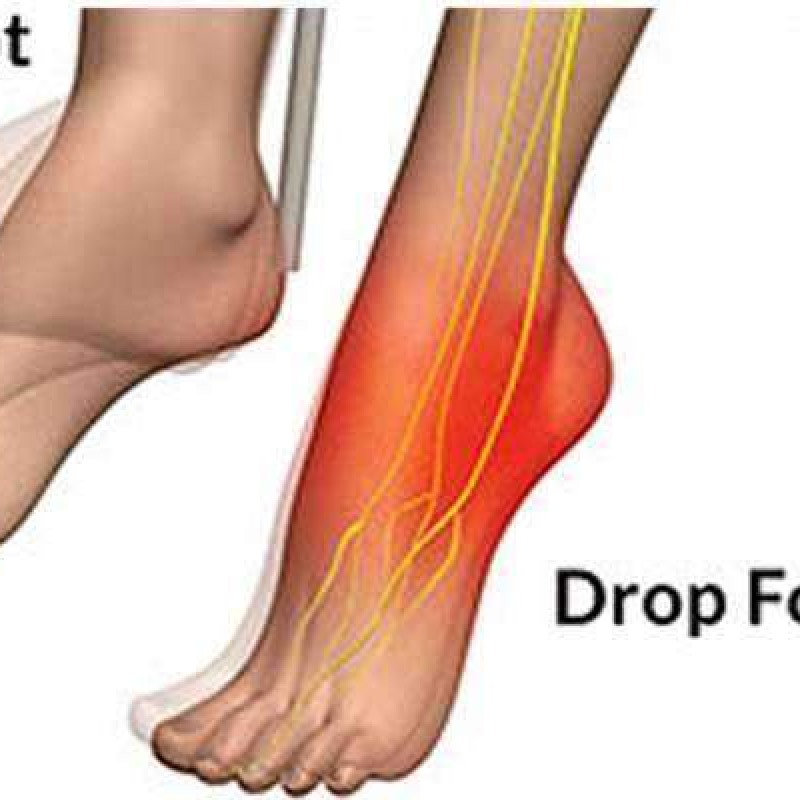 Βοήθημα ποδοκνημικής για χαλαρή πάρεση άκρου ποδός