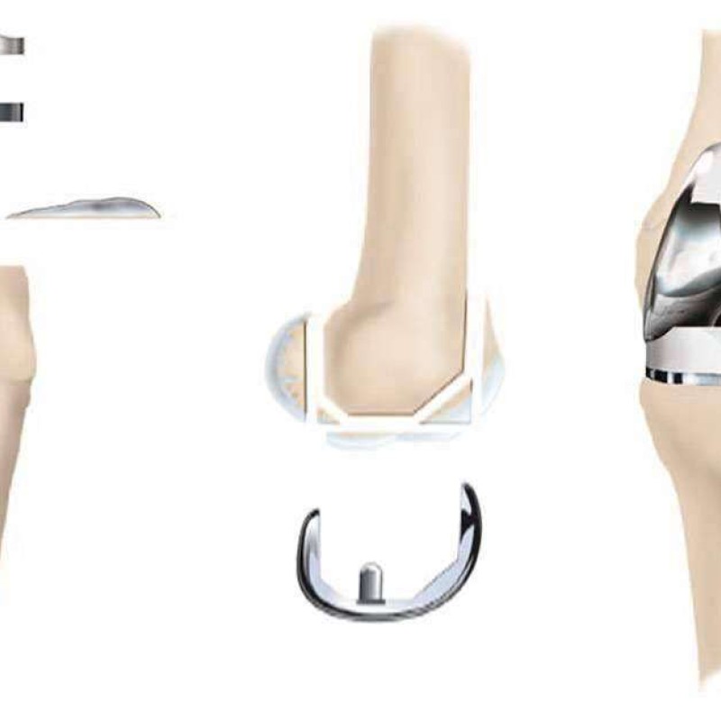 Νέο γόνατο εφ όρου ζωής Νέο γόνατο εφ όρου ζωής